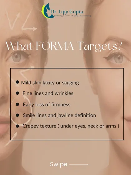 This list outlines the specific concerns that Forma effectively targets. It is ideal for mild skin sagging, fine lines, early loss of firmness, smile lines, and crepey texture under the eyes or on the neck.