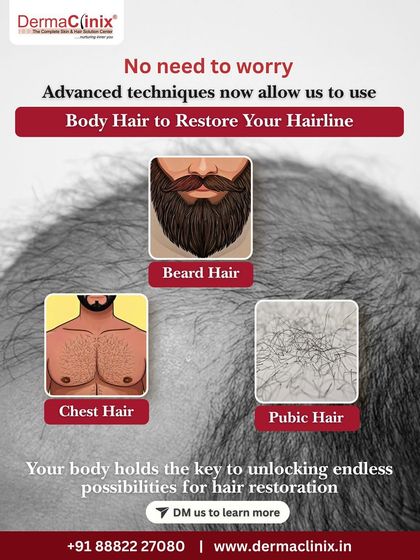 When the scalp donor area is insufficient, we have advanced techniques that allow us to use body hair from the beard, chest, or other areas to restore your hairline. Your body holds more possibilities for hair restoration than you might think.