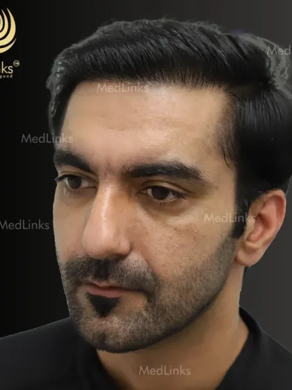 A side profile of the patient after his hair transplant. The restored hairline frames his face perfectly, creating a natural and balanced look.