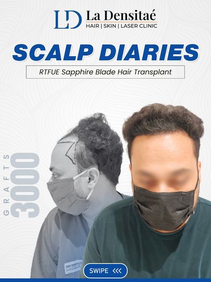 With 3,000 grafts using the RT-FUE Sapphire Blade Technique, Anurag got back his natural hair and his confidence. This technique allows for finer incisions, leading to faster healing and denser packing of grafts.