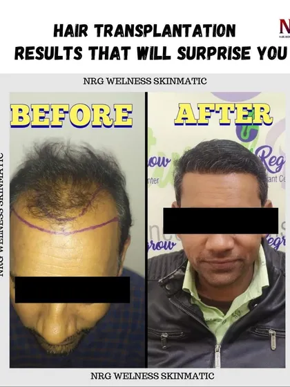 The results of our hair transplantation can be surprising. This client now enjoys a full head of hair, which has taken years off his appearance and boosted his self-esteem.
