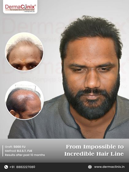 From impossible to incredible. This patient achieved a full hairline after a 5000 follicular unit B.E.S.T. FUE procedure, with results shown 10 months post op. This demonstrates our ability to handle extensive hair loss.