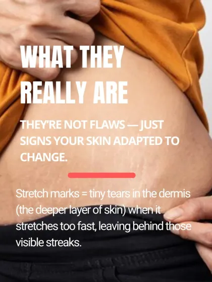Stretch marks are not flaws, but tiny tears in the dermis that occur when skin stretches too fast. They are simply signs that your skin has adapted to change.
