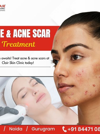 An overview of our comprehensive approach to treating both active acne and the scars it leaves behind. We are committed to helping you achieve the clear skin you deserve.