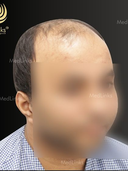 The patient's hair loss from the side before the procedure.
