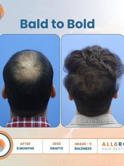 From Bald to Bold. This 8-month result for a Grade 5 case, using 3650 grafts, shows a complete transformation. The close-up of the hairline demonstrates the natural and dense packing of follicles.