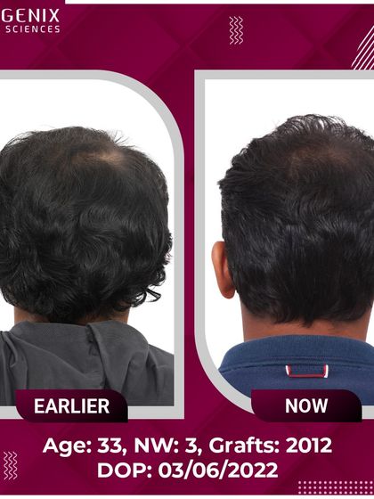 A 33-year-old's successful restoration from Grade 3 baldness with 2012 grafts.