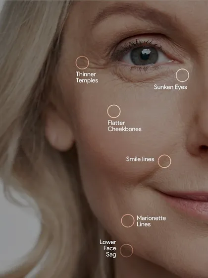 This infographic details the specific areas of the face that show signs of aging, such as thinner temples, smile lines, and marionette lines. Understanding this facial map helps in creating a targeted and effective treatment plan.