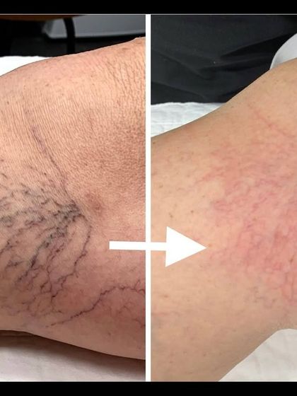 This before-and-after shows the incredible results of microsclerotherapy for leg spider veins. I perform this minimally invasive treatment to make unsightly veins fade and disappear, restoring clear, beautiful skin.