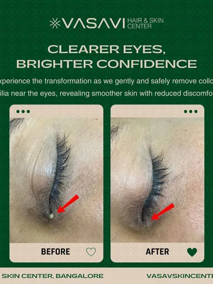 This before and after image shows the successful removal of colloid milia from the delicate eye area. This is a precise procedure that should only be performed by a professional to avoid scarring. My goal is always to provide safe, effective treatments that restore both skin health and patient confidence.