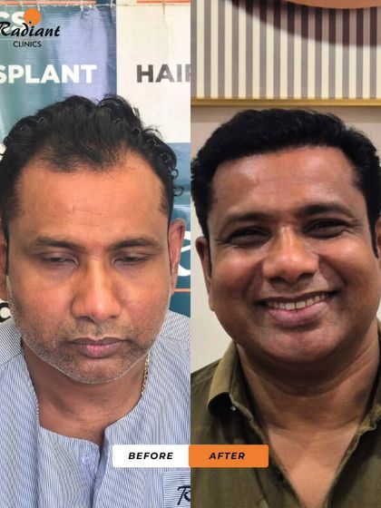 The smile in the 'after' photo says it all. We not only restored his hair but also his happiness and self-esteem with a result that looks and feels completely natural.