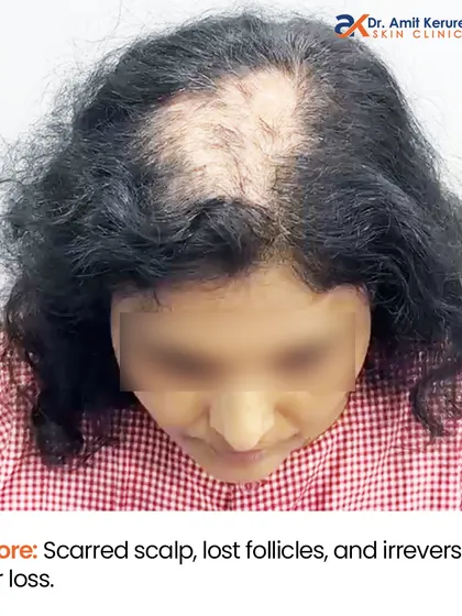 This is the 'before' state of the patient with Lichen Planopilaris. You can see the scarred scalp, lost follicles, and irreversible hair loss, which presented a significant surgical challenge.