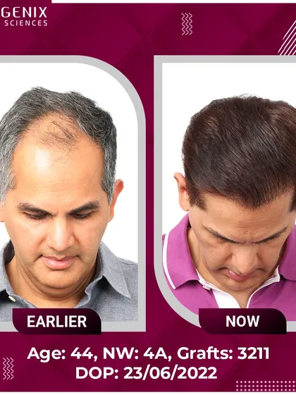 Real results for real people: a 44-year-old's successful 3211-graft transplant.