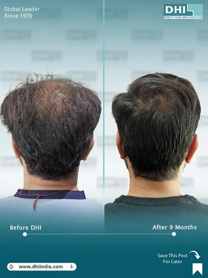 A rear view of the 9-month transformation, showing excellent coverage on the crown and back of the head. Our technique ensures a natural look from every angle.