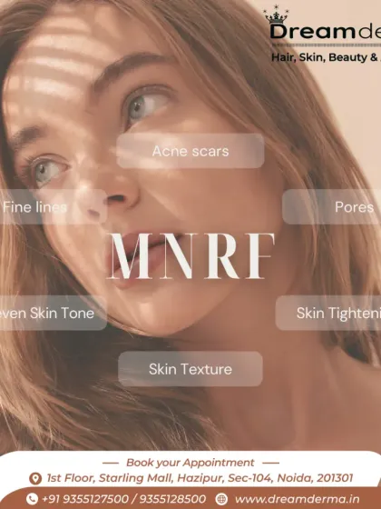 This graphic illustrates the many concerns that Microneedling with Radiofrequency (MNRF) can address, including acne scars, pores, skin tightening, and uneven skin tone.