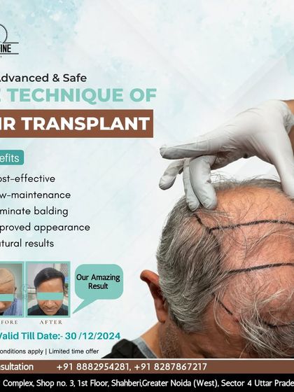 An informational graphic explaining the benefits of our advanced FUE hair transplant technique. We highlight that it is a cost-effective, low-maintenance solution that eliminates balding with natural-looking results.