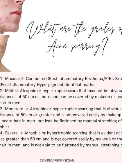 Acne scarring is graded from 1 to 4 based on severity and visibility. This helps in setting realistic expectations and planning the most appropriate course of treatment.