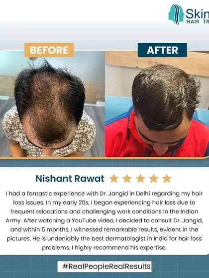 Seeing my patients regain their confidence is the most rewarding part of my work. This is Nishant, who serves in the Indian Army. After experiencing hair loss in his early 20s, he came to me for a consultation, and we achieved these remarkable results in just five months.