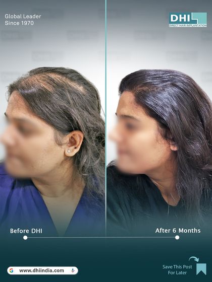 A side-profile view of the same female client's 6-month progress. The restored hairline and increased thickness are clearly visible, showcasing a natural and beautiful result.