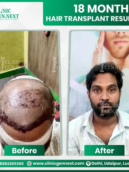 Patience and the right technique deliver incredible results. At 18 months, this patient's hair shows excellent density and shape, completely covering the previously bald scalp.