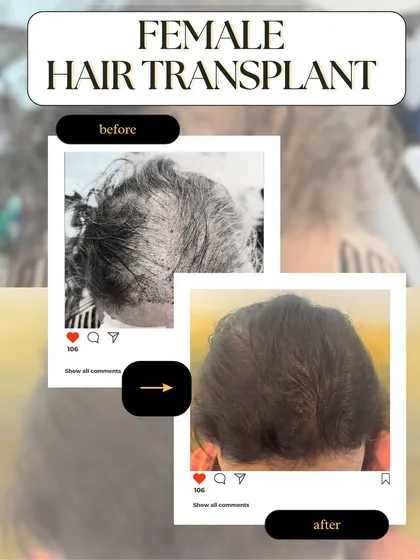 Hair loss is not just a male concern. We provide specialized FUE hair transplant procedures for women, focusing on restoring density and confidence with results that are both beautiful and natural.
