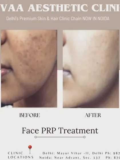 A compelling before-and-after result of our Face PRP treatment. This image demonstrates a visible reduction in skin pigmentation and improved texture, showcasing the treatment's effectiveness for achieving clearer, more even-toned skin.