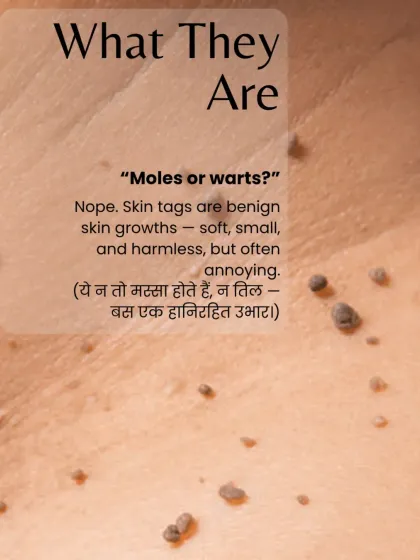 Skin tags are neither moles nor warts. They are benign, soft skin growths that are medically harmless but can be cosmetically annoying. I can remove them quickly and safely in a single session.