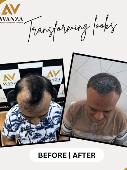 We successfully treated this client's advanced hair loss, restoring coverage across the entire top of his scalp for a complete and natural-looking transformation.
