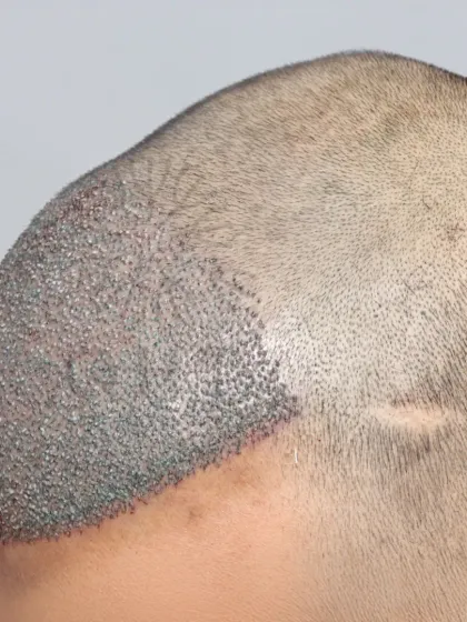 A high-density transformation in progress. 4000 grafts were implanted to rebuild the hairline and cover the mid-scalp.