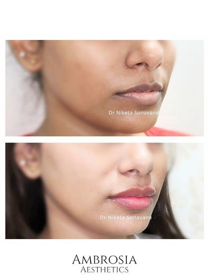 A subtle yet impactful under-eye and mid-face rejuvenation. By carefully placing filler, I was able to smooth the under-eye area and provide support to the cheeks, creating a seamless and refreshed look.