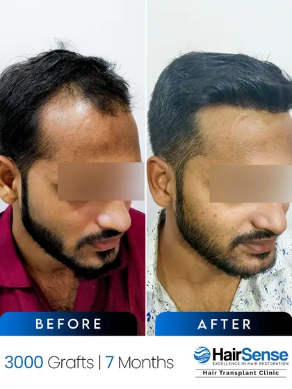 This angled view of our 3000-graft case shows how the new hair blends perfectly with the existing hair for a seamless result.