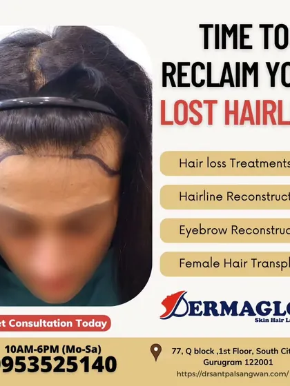 The first step in a successful transplant is designing the perfect hairline. We work with each client to draw a custom hairline that complements their facial structure, ensuring the final result is both natural and aesthetically pleasing.