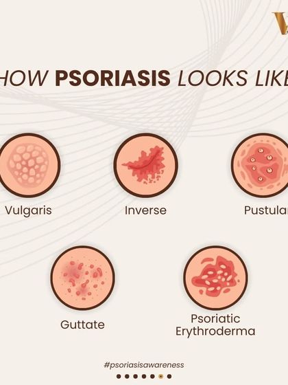 This infographic illustrates the different types of psoriasis, including Vulgaris, Inverse, Pustular, Guttate, and Psoriatic Erythroderma. Each type looks different and may require a unique treatment approach, emphasizing the need for an expert diagnosis.