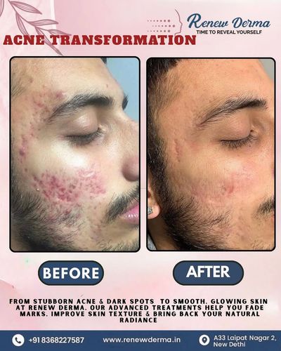 Advanced Skin Treatments