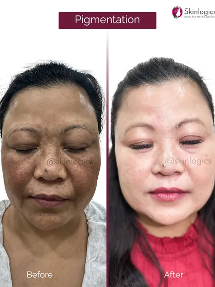 This before and after comparison highlights a dramatic improvement in facial pigmentation. The patient's skin on the left shows extensive dark spots and uneven tone, which is visibly lightened and clarified in the after photo, resulting in a radiant and healthier-looking complexion.