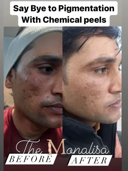 This before and after showcases the power of our targeted chemical peel treatment. Notice the dramatic improvement in skin clarity and the reduction of deep-seated pigmentation, leading to a brighter, more uniform skin tone.