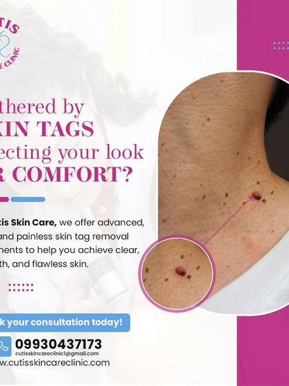 Skin tags can be bothersome, affecting your look and comfort. We offer advanced, safe, and painless skin tag removal treatments designed to give you clear, smooth, and flawless skin with a quick and effective procedure.