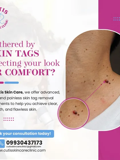 If you are bothered by skin tags affecting your comfort or appearance, we can help. This image shows a close-up of common skin tags on the neck, which we treat with advanced, safe, and painless removal methods for clear, smooth skin.