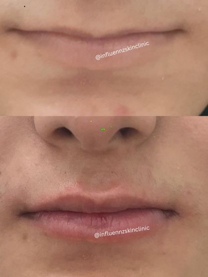 A clear comparison showing the subtle yet significant improvement in lip volume and shape after a filler treatment.