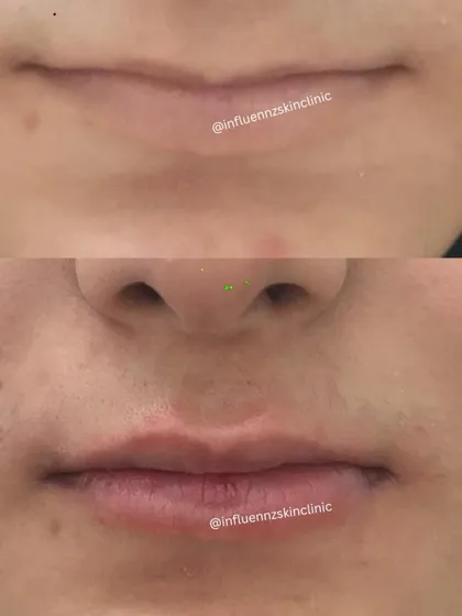 A clear comparison showing the subtle yet significant improvement in lip volume and shape after a filler treatment.