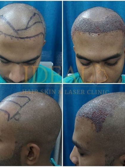 A four-panel view showing the patient's hair loss pattern from the front and side, and the corresponding views immediately after the transplant procedure.