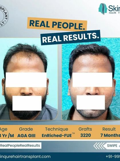 A side-profile view of the 28-year-old patient with AGA GIII hair loss. The 7-month result after 3220 grafts shows how a well-designed hairline and temple restoration create a balanced and natural look.
