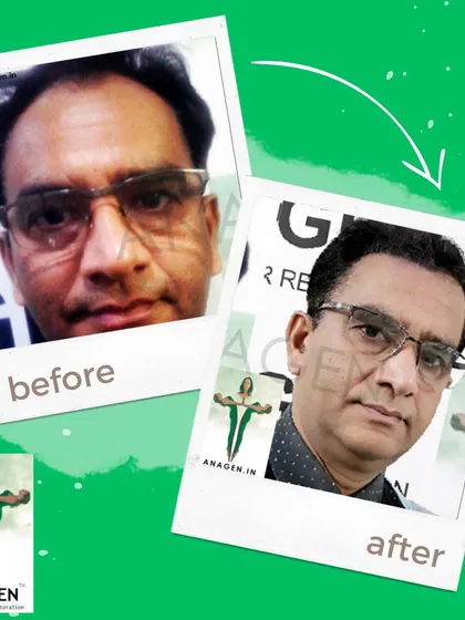A before and after transformation showing a significant improvement in hair density and overall appearance, thanks to our advanced hair restoration methods.