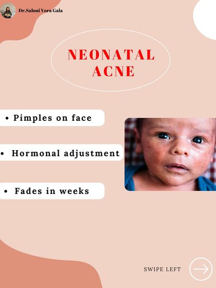 Neonatal acne presents as small pimples on a baby's face. This is a result of hormonal adjustments after birth and usually fades within a few weeks without intervention.