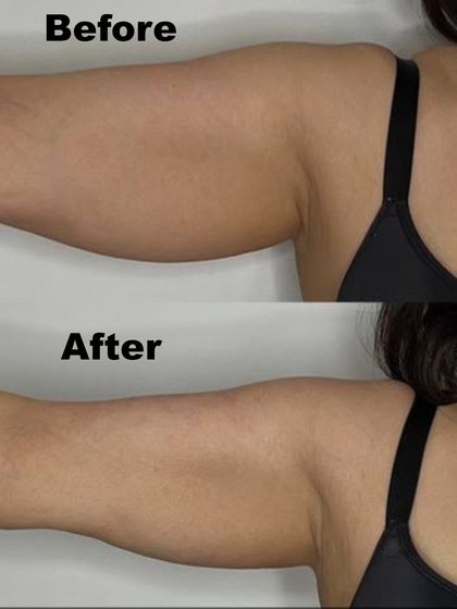 Another example of our successful arm tightening procedure. We help clients achieve smoother, more toned-looking arms without surgery.