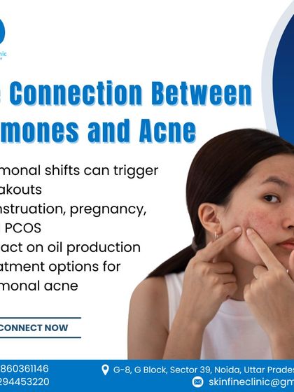 This visual explains the direct connection between hormonal shifts and acne. Conditions like PCOS, menstruation, and pregnancy can trigger breakouts, which require a specific medical approach to manage.