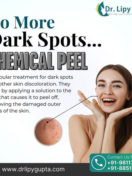 Chemical & Cosmelan Peels for Pigmentation photo 6