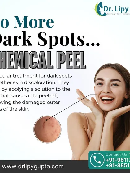 No more dark spots. A chemical peel is a highly effective treatment for skin discoloration. This graphic explains how the solution works by causing the damaged outer layers of skin to peel off, revealing the healthier, more evenly toned skin underneath.