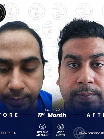An impressive 11-month result from a 4500-graft BIO FUE transplant. The patient's hair is thick, healthy, and completely natural-looking.