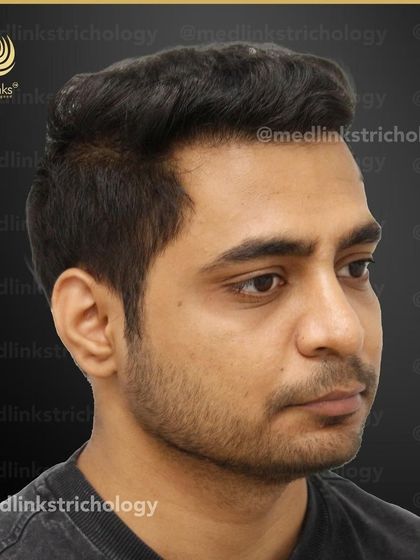 The final result from the side, showing a natural and dense hairline.